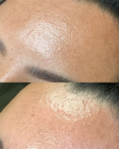 Sofia - 🦠Fungal folliculitis acne progress Fungal acne is a unique form