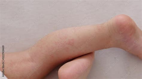 atopic eczema dermatitis sleeping baby legs, red irritation allergic ...