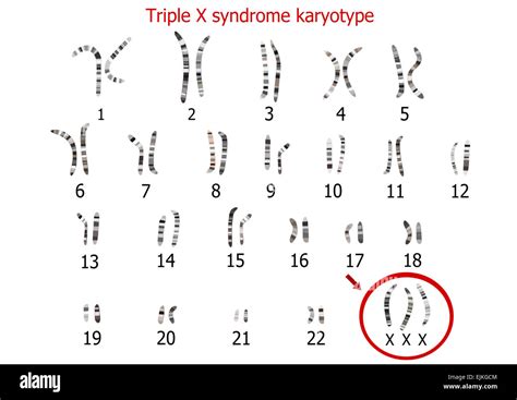 Triple X syndrome karyotype Stock Photo: 80335268 - Alamy