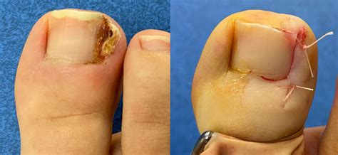 Ongle incarné du gros orteil | Causes, traitement, chirurgie | CPHG Paris