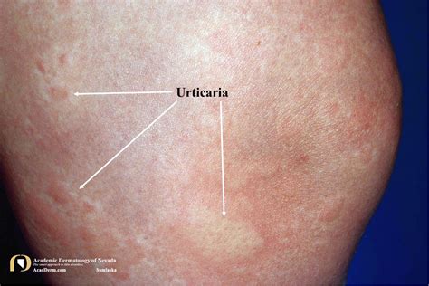 urticaria acute  chronic hives academic dermatology  nevada