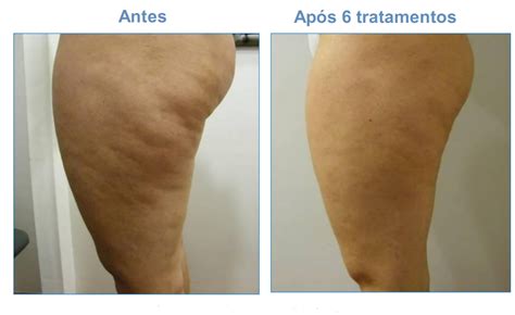 Antes E Depois Drenagem Linfática