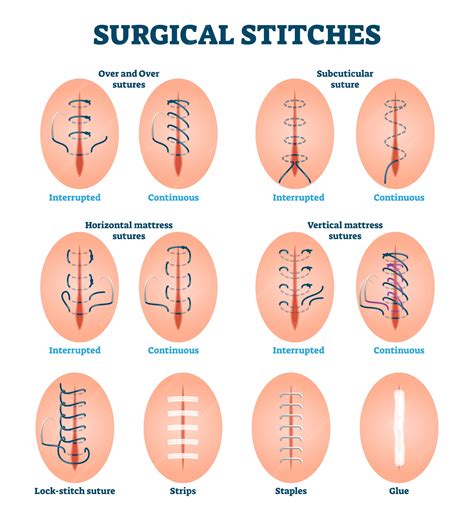Premium Vector | Surgical stitches illustration. Labeled various cut