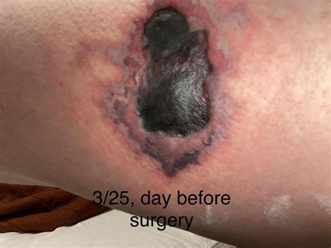 Brown recluse bite : r/BrownRecluseBites