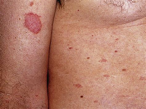 Pityriasis Rosea | Anesthesia Key