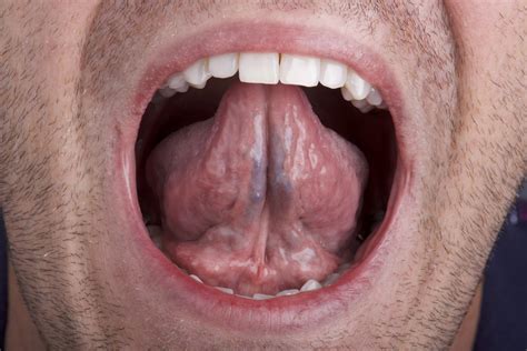 Normal Tongue Underneath Geographic Tongue | Altru Health System