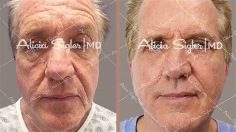 face lift