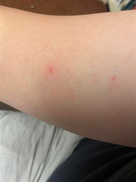 HIV Rash?? : r/HIV
