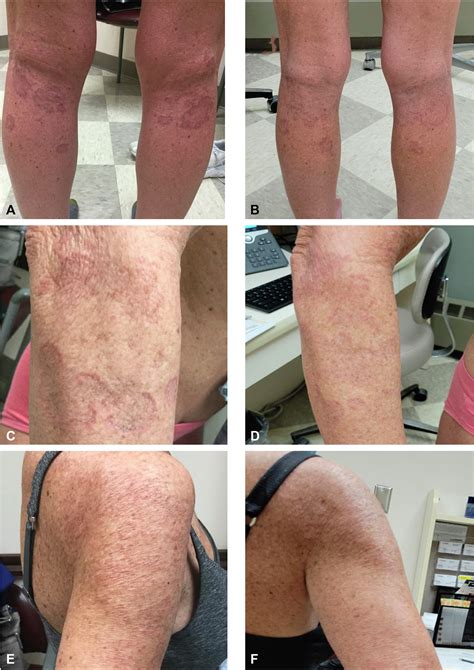 Anulare Granuloma Annulare Possibly Secondary To Oral Treatment With