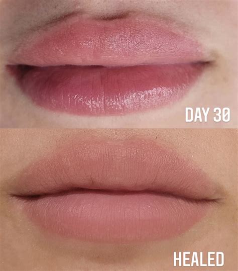 Are Fordyce Spots Poppable at Gayla Wilson blog