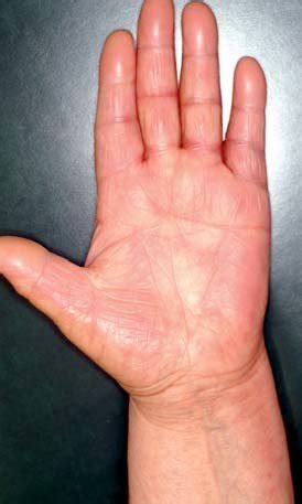 Hand-foot syndrome (palmar-plantar erythrodysesthesia) during treatment... | Download Scientific ...