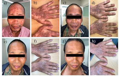 Figure 1 from Successful Treatment of Chronic Actinic Dermatitis with ...