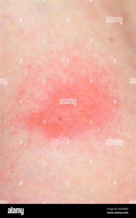 Bee sting. Bee stings can cause pain, redness and swelling for up to 48 ...