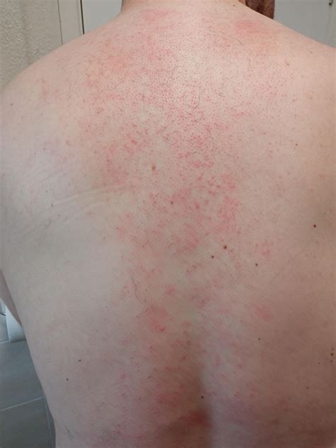 Please help, does this look like malassezia folliculitis or does anyone