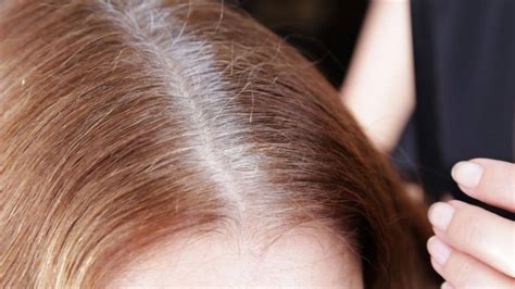 O Que Causa Cabelo Branco Em Pessoas Jovens