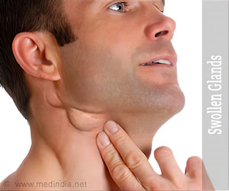 glands   neck swollen swollen cervical lymph nodes