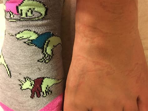 Marks From Wearing Socks at Dennis Marquis blog