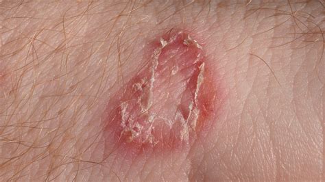 Ringworm Face