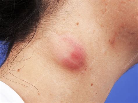 Sebaceous Cyst In Groin Area Male Pictures at Fred Mounce blog
