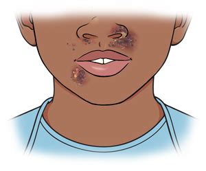 child  impetigo saint lukes health system