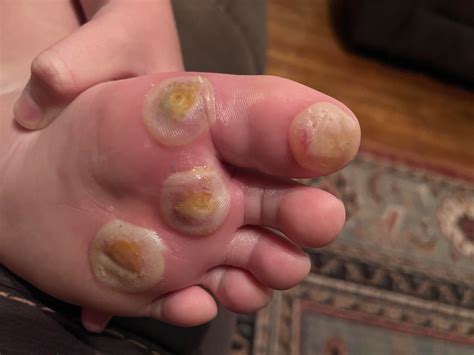 how to tell a wart is dying 3