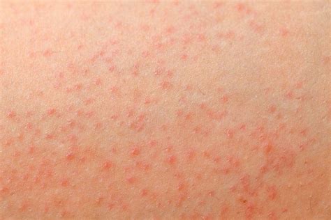Itchy Red Bumps, Skin Bumps, Home Remedies For Rashes, Itching On Legs ...