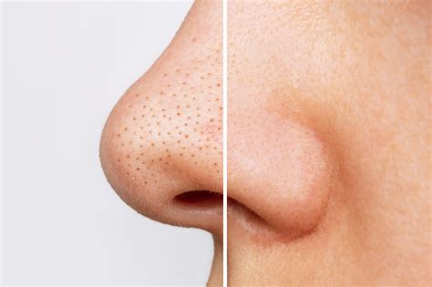 Blackheads On Nose Home Remedies