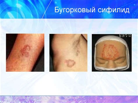 Сифилис - презентация онлайн