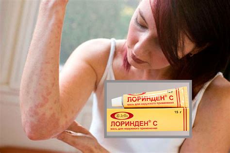 Лоринден с: мазь – инструкция по применению, цена, отзывы, от чего ...