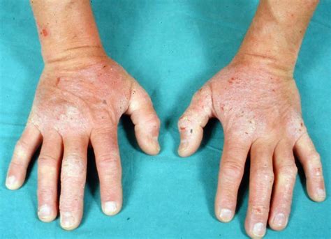 dermatitis herpetiformis  symptoms diagnosis  treatment