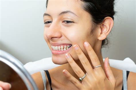 how long do braces take to stop hurting