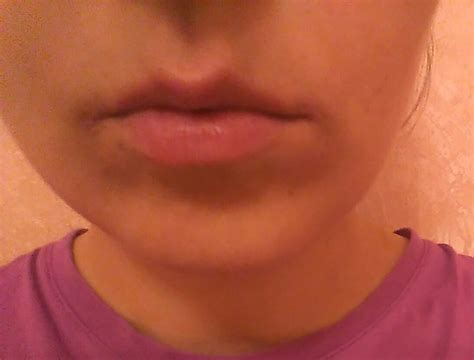 Синяки (потемнения) под уголками губ — 14 ответов | форум Babyblog