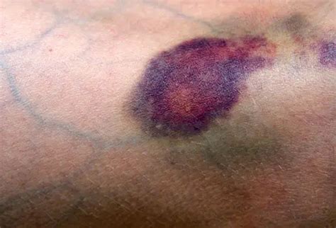 hematoma  ecchymosis