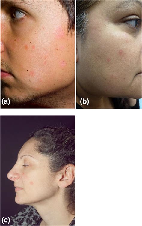 facial discoid dermatosis  cosmetically disfiguring  challenging