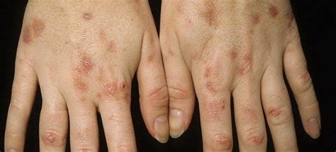 Порфирия - признаки, причины, симптомы, лечение и профилактика - iDoctor.kz