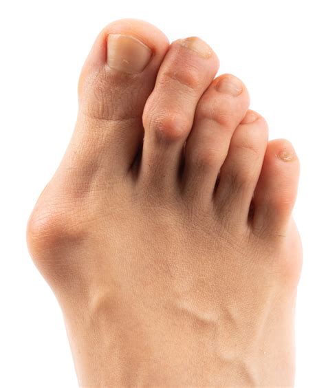 Medial Bunion at Dane Wallace blog