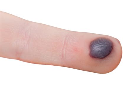 blisters types symptoms  diagnosis treatment
