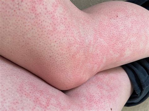 Efectos Secundarios De La Prednisona