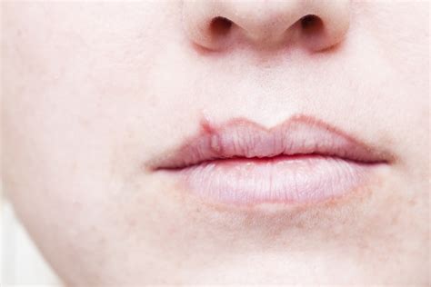 Cold Sores In Mouth