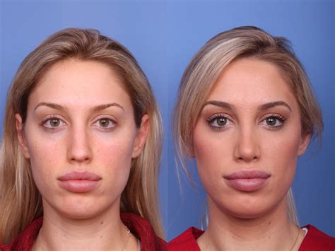 rhinoplasty    pictures case  scottsdale az