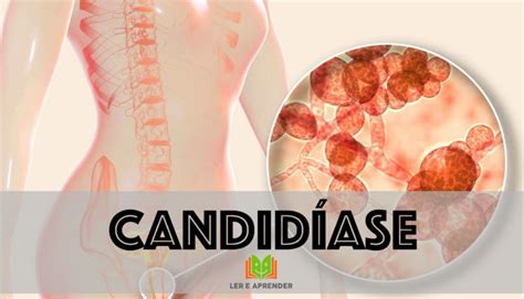 O Que Causa A Candidíase - O que é candidíase - Sintomas, tratamento, candidíase recorrente