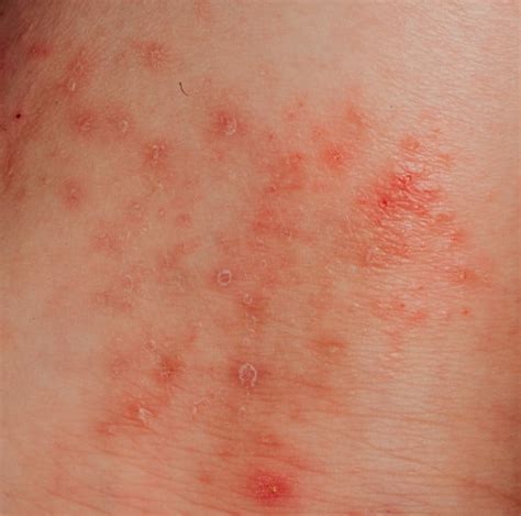 O Que É Eczema Na Pele - Eczema: o que é, tratamentos e sintomas na pele - Minha Vida