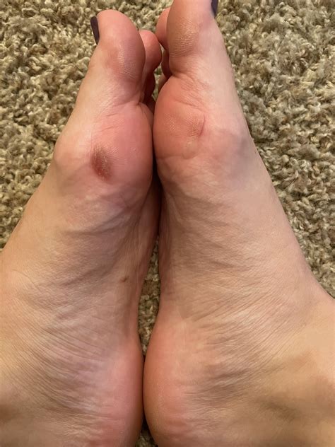 Runners blisters! Is it my shoes? I’ve never had this kind of blister