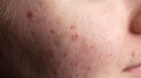 Muitos Cravos No Rosto - Cravos no rosto: o que causa e como tirar sem deixar marcas? | Garnier