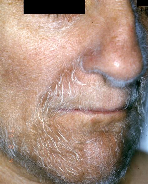 Hypertrichosis Lanuginosa Acquisita