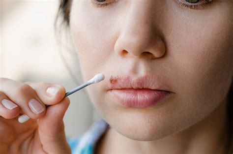 Bolhas Na Boca Baixa Imunidade - Herpes 2 Na Boca