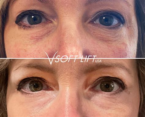 thread lift haus   aesthetics