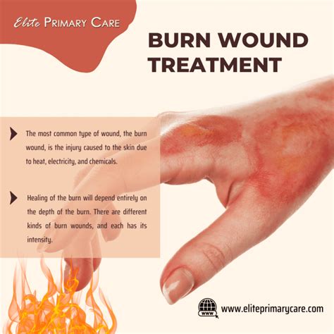 A Complete Guide To Burn Wound Treatment in Greenville, TX | Board ...