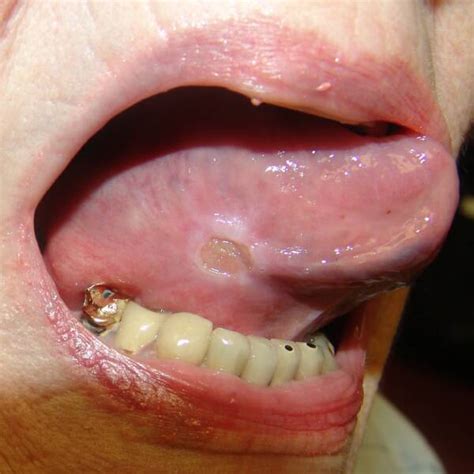 Medicine for health care: Canker Sores (Aphthous Ulcers)