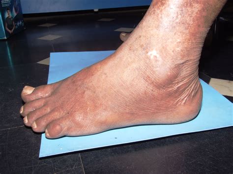 3 questions with answers in BULLOUS PEMPHIGOID | Science topic